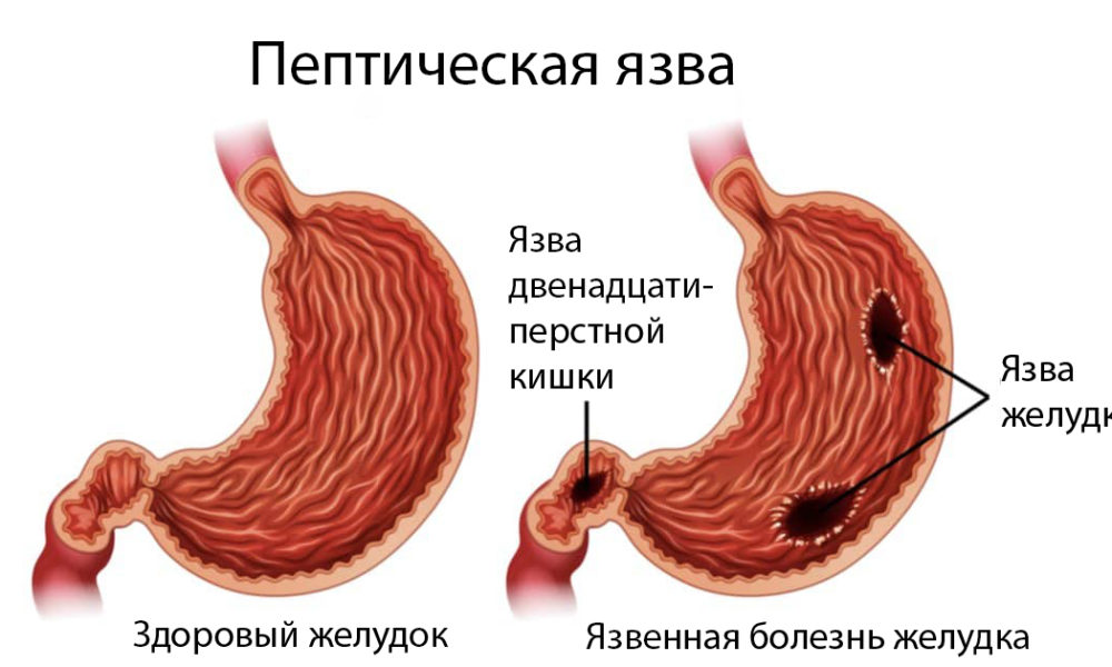 Что такое язва желудка и чем она опасна