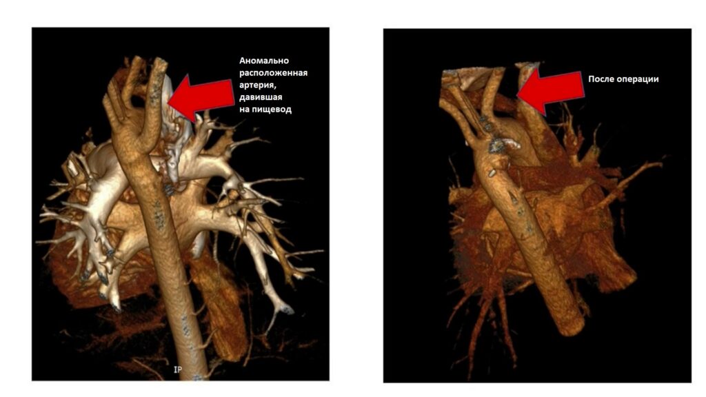 Томографический снимок сердца - ДО и ПОСЛЕ операции