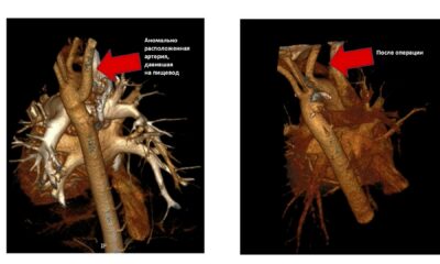 Томографический снимок сердца - ДО и ПОСЛЕ операции