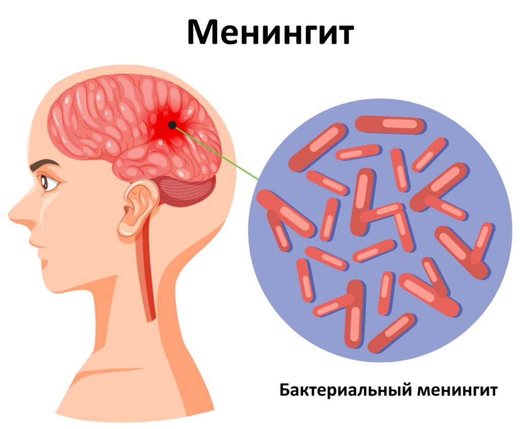 Бактериальный менингит