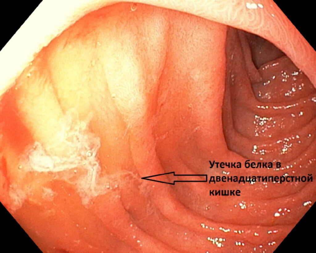 НМИЦ Мешалкина - Обнаружение места исхода белка в двенадцатиперстной кишке