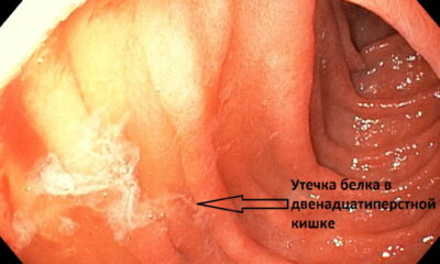 НМИЦ Мешалкина - Обнаружение места исхода белка в двенадцатиперстной кишке