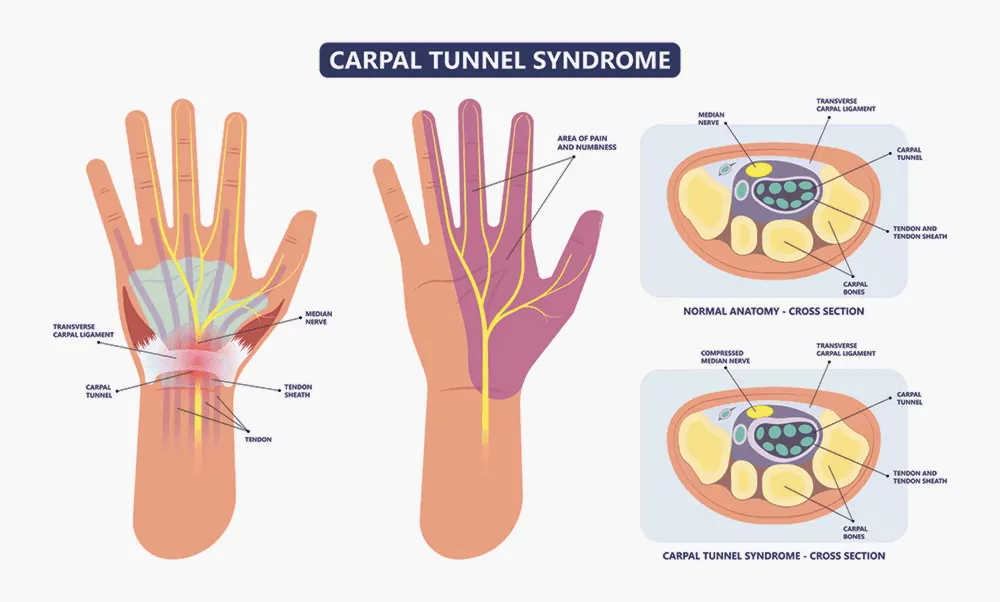 Туннельный синдром - Причины и лечение